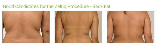 Coolsculpting Procedure: Body Back