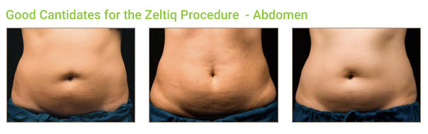 Coolsculpting Procedure: Abdomen