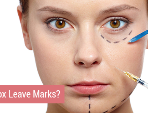 Does Botox Leave Injection Marks?