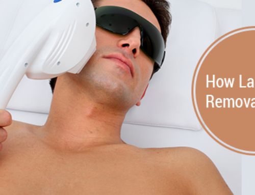 How Does Laser Hair Removal Work?