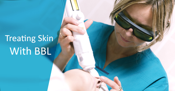 Treating Skin With BBL