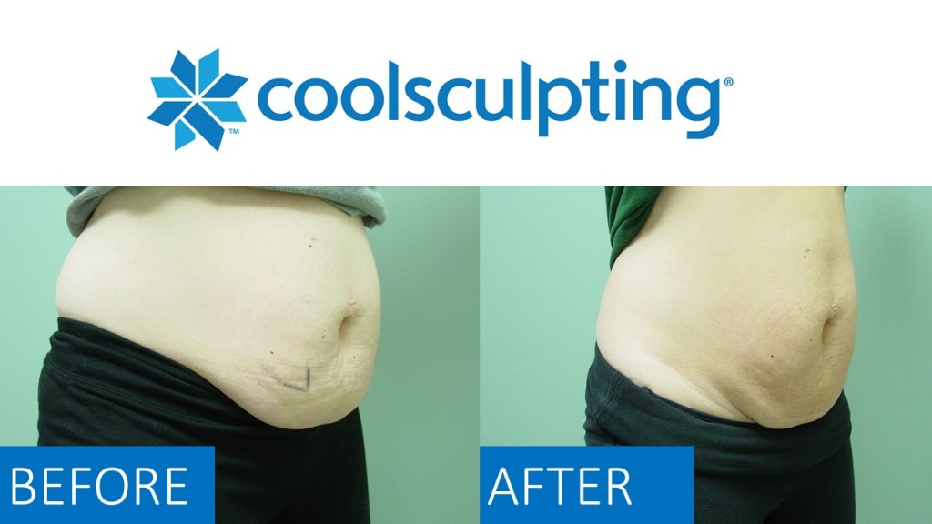 CoolSculpt2-1024x576