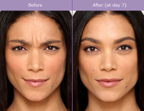 How Botox Can Solve More Than Just Wrinkles!