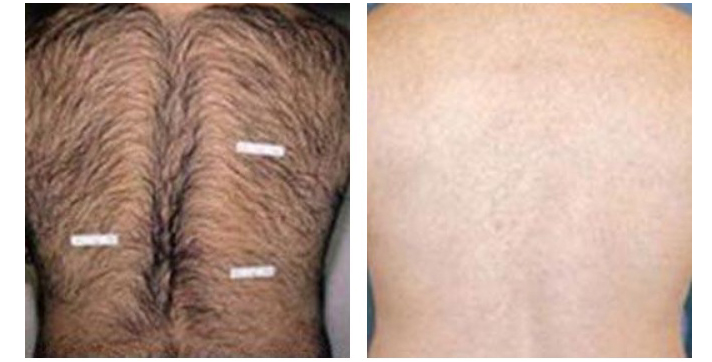 LightSheer Laser Hair Removal Treatment Richmond Hill | Centre for Dermatology LightSheer Laser Hair Removal Treatment Richmond Hill | Centre for Dermatology