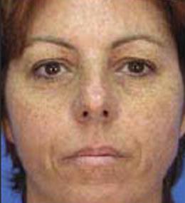 before-microlaserpeel