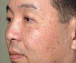 before-profractional-treatment