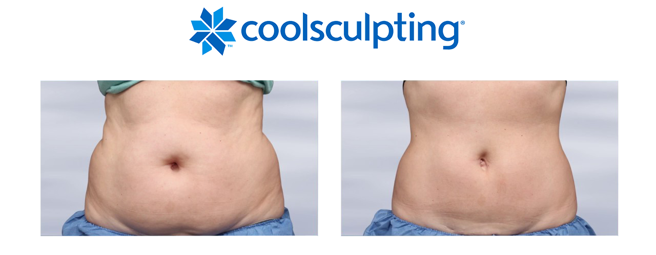 Coolsculpting Landing Page 2 - The Centre for Dermatology Coolsculpting Landing Page 2 - The Centre for Dermatology